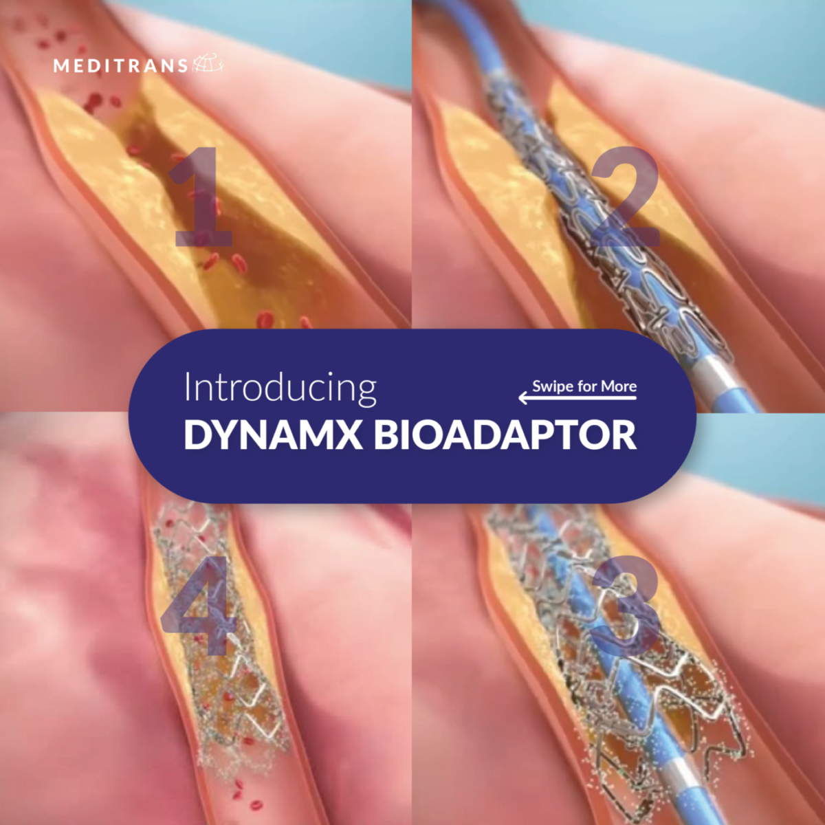 Inovasi Pengobatan Penyakit Arteri Koroner dengan Elixir DynamX Bioadaptor