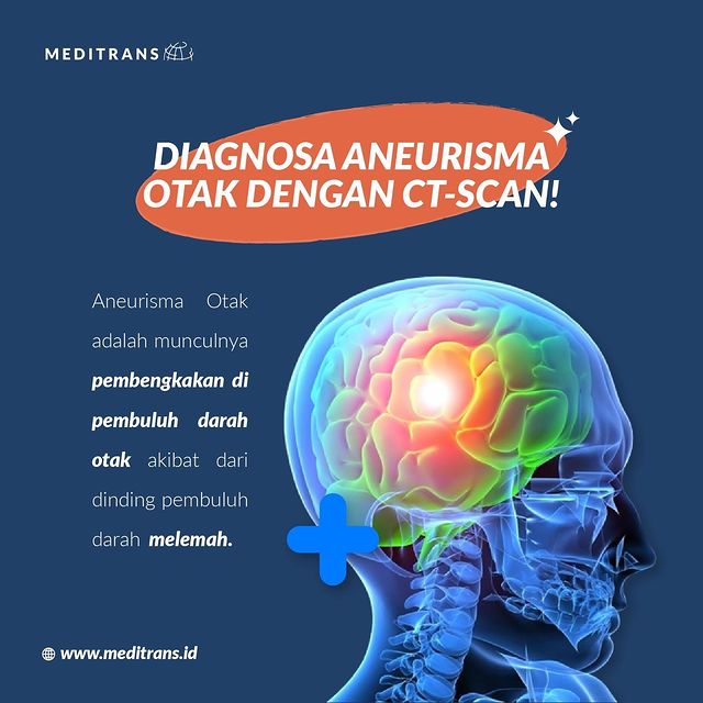 Diagnosa Aneurisma Otak Dengan CT-Scan