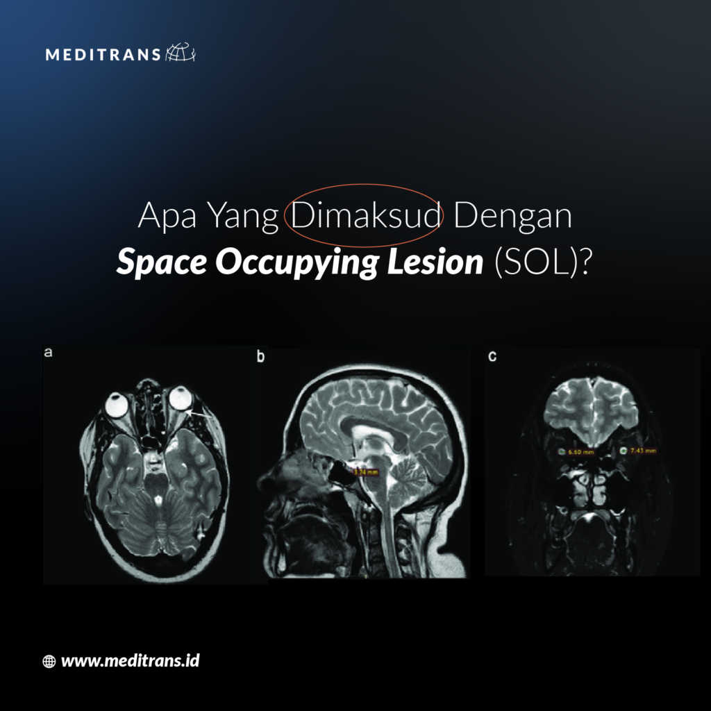 Apa Itu Space Occupying Lesion (SOL) ?
